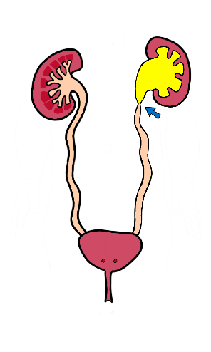 היצרות מוצא אגן כליה – Ureteropelvic Junction (UPJ) Obstruction