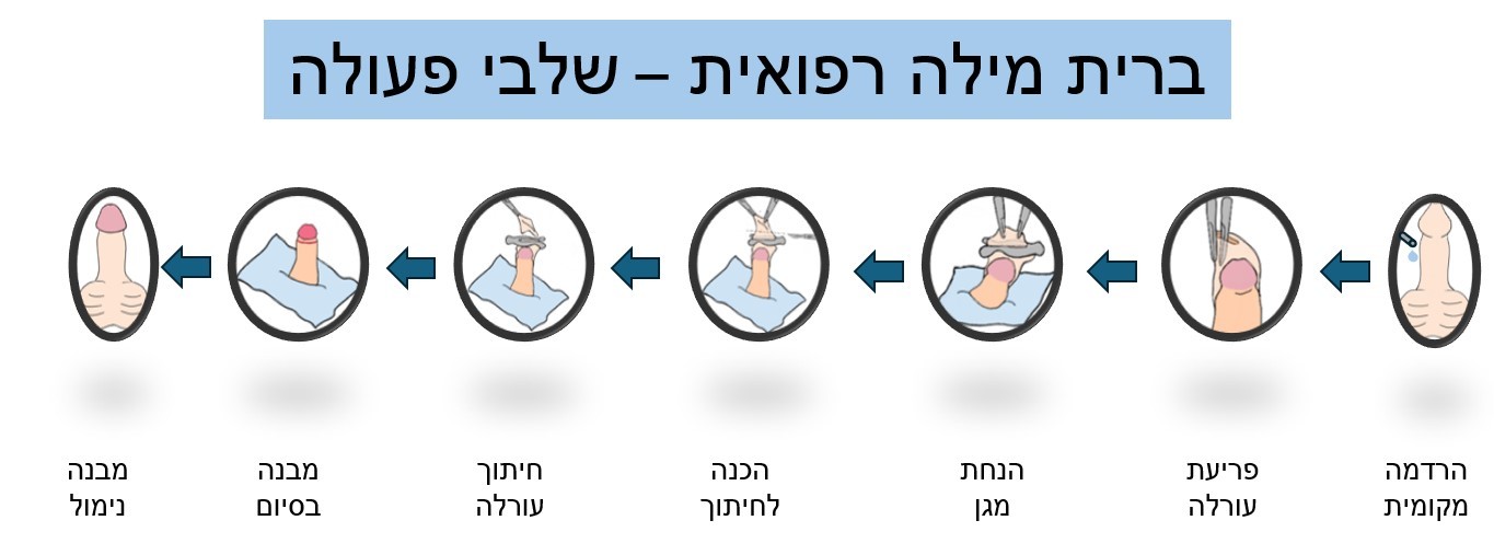 ברית מילה רפואית – שלבי פעולה