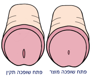 היצרות פחת שופכה